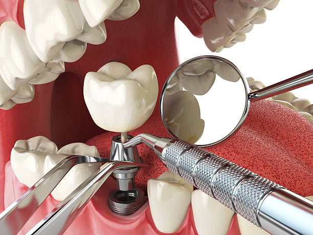Best Emergency Broken Tooth Repair in Georgetown, IN